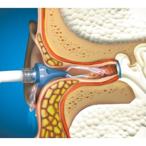 OtoClear oorspoel systeem - Afbeelding 2