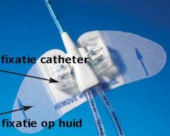 Statlock Picc Plus Catheter Bevestigingssysteem